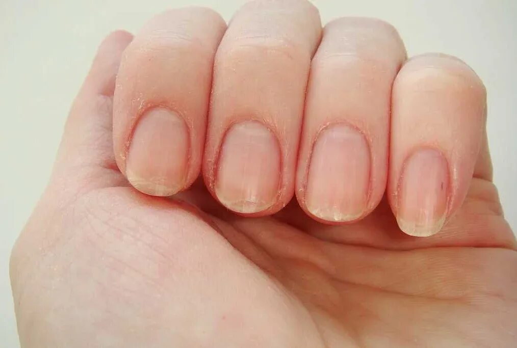 Бугристые ногти на большом пальце. Почему ногти волнистые. Почему ногти волнистые. Ониходистрофия - онихолизис. Поперечные борозды бо-рейли.