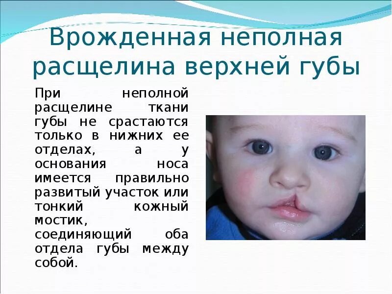 Заячья губа (расщелина нёба): причины, симптомы и лечение в статье пластического