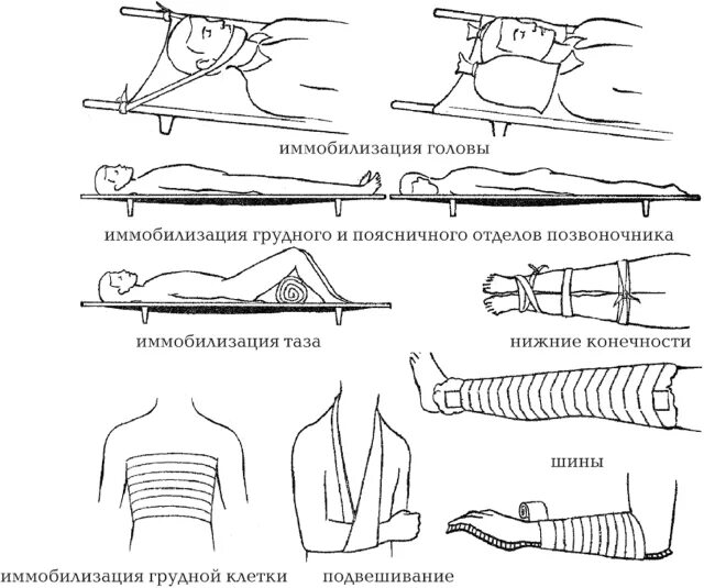 Шина при травме головы. Алгоритм транспортной иммобилизации при переломах. Шины для транспортной иммобилизации. Транспортная иммобилизация типы шин. Иммобилизация поврежденной части тела при переломе костей.