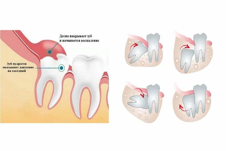 Воспаление зуба мудрости. Воспаление и прорезание зуба мудрости. Зубы болят и сверху и снизу