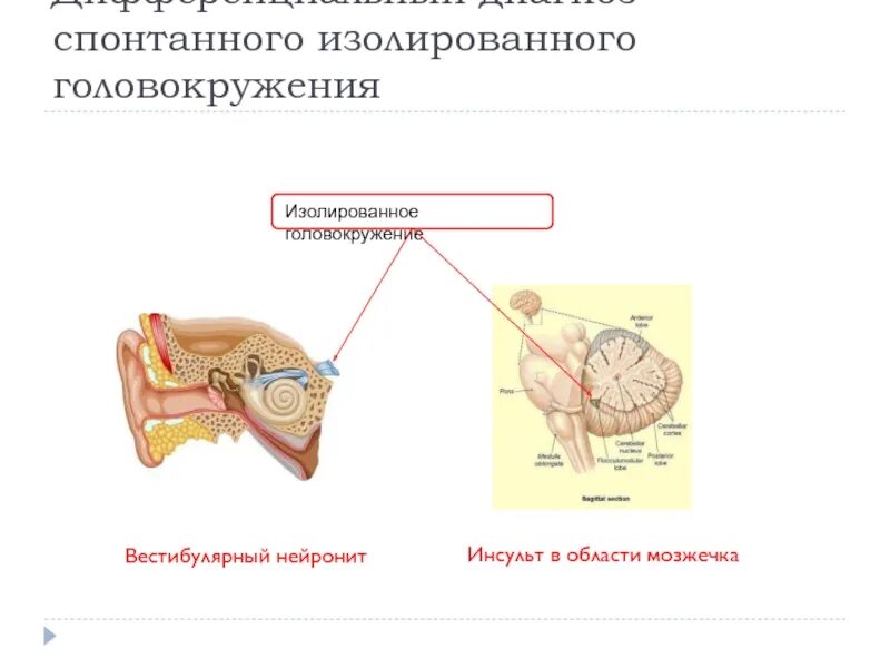 Вестибулярный нейронит симптомы и лечение. Вестибулярный нейронит дифференциальная диагностика. вестибулярный нейронит герпетический. правосторонний вестибулярный нейронит. нистагм при вестибулярном нейроните.