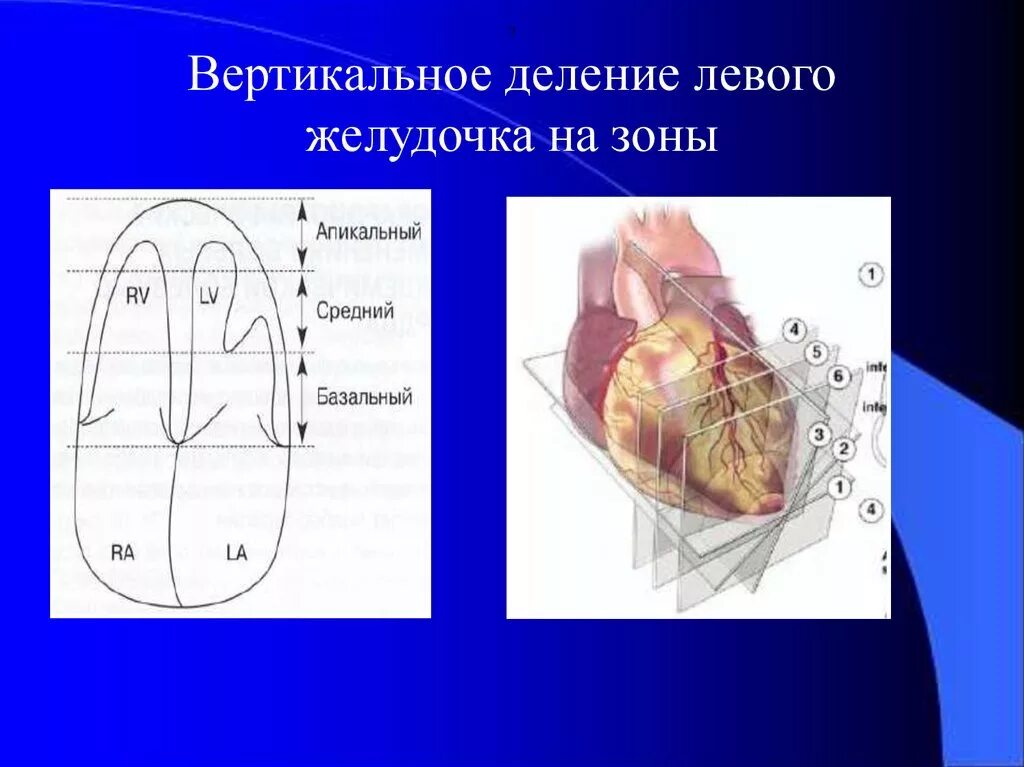 Зоны левого желудочка ЭХОКГ. Сегменты левого желудочка на ЭХОКГ. Сегменты левого желудочка сердца. Оценка локальной сократимости миокарда левого желудочка.