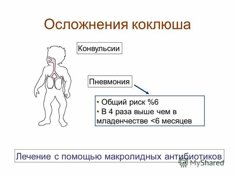 осложнения после коклюша у детей