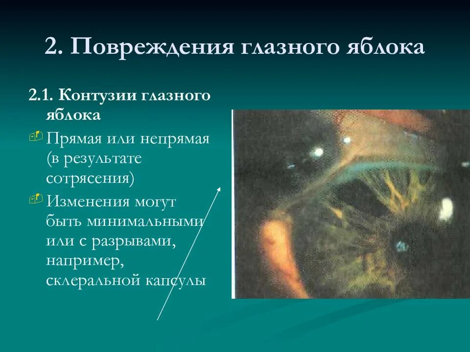 Что такое контузия словами и последствия. Повреждение глазного яблока. Контузия глазного яблока. Осложнения при контузии глазного яблока. Ушибы (контузии) глазного яблока.