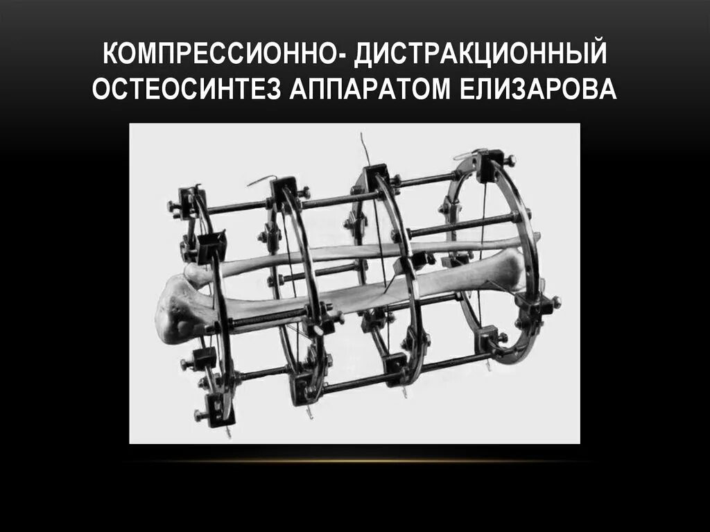Чрескостный компрессионный остеосинтез. Остеосинтез • чрескостный остеосинтез. Стержневые аппараты внеочагового остеосинтеза. Стержневые аппараты внеочагового остеосинтеза. Дистракционная остеосинтез.