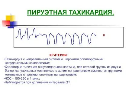 Пируэтная тахикардия