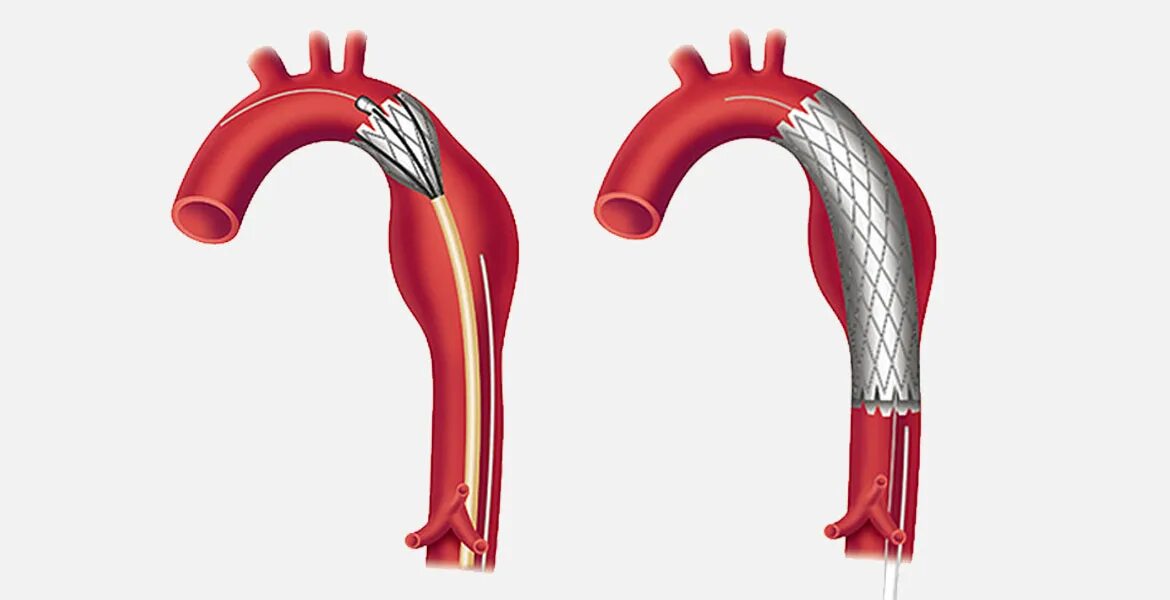 Аневризма стент. Стент графт грудной аорты. Стент брюшной аорты аневризма. Аневризма аорты стент графт. Стент графт аорты операция.