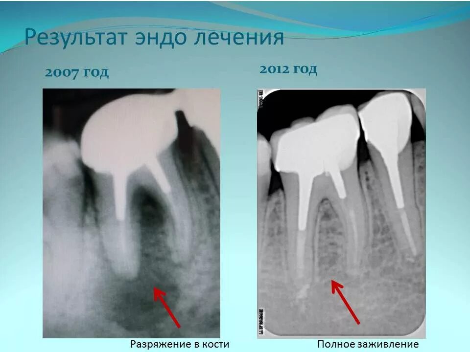 Снимок 46 зуба корневого канала. Воспаление корня зуба на рентгене.