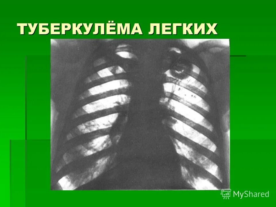 Солитарная гомогенная туберкулема. Кальцинированная туберкулома. Туберкулема легкого рентген. Туберкулемы на рентгене. Туберкулема с распадом на кт.