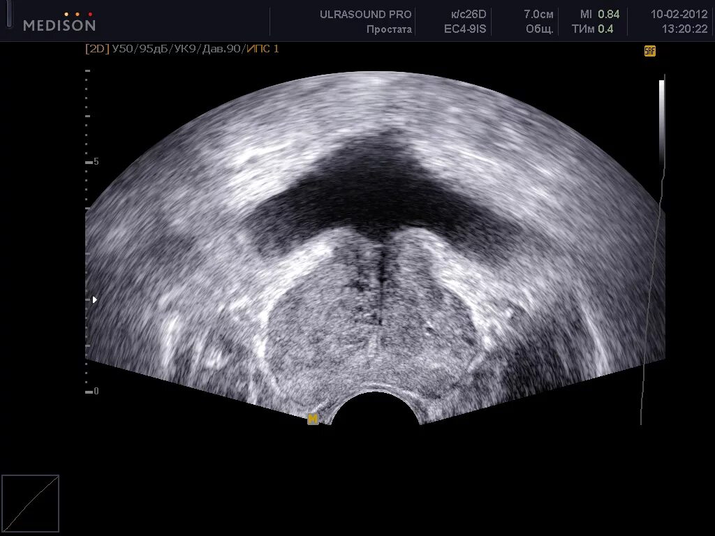 УЗИ предстательной железы абдоминальным датчиком. Ультразвуковое исследование предстательной железы трансректальное. УЗИ предстательной железы трансабдоминально. Билатеральная аденома предстательной железы УЗИ.