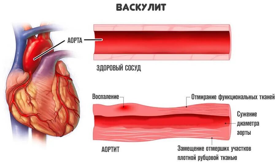 Сужение сосудов симптомы причины. Васкулит сосудов симптомы. Васкулит поражение сосудов кожи. Воспаление стенок сосудов это васкулит?.