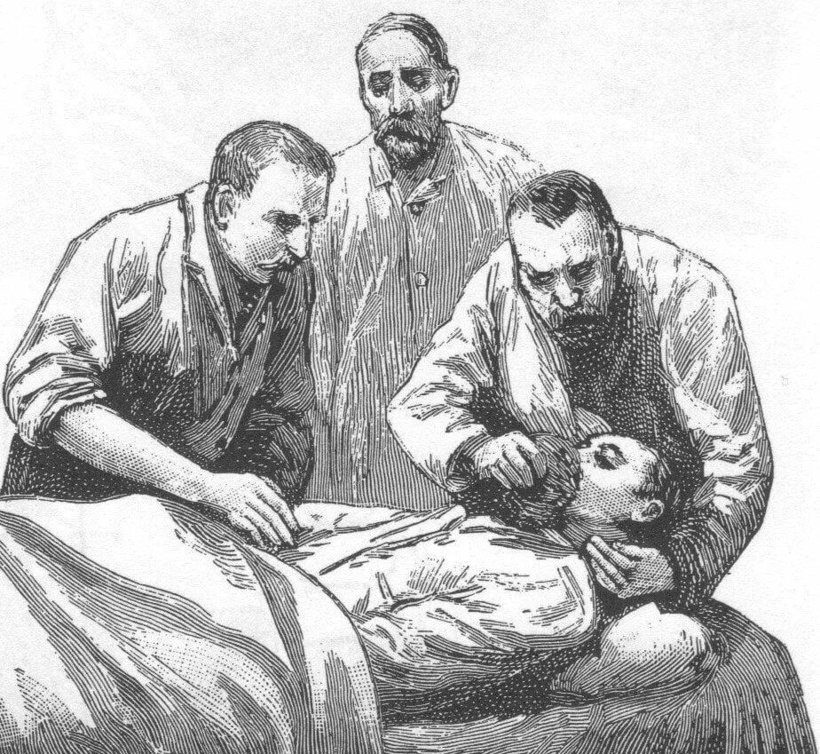 Наркоз раньше. Первая операция под наркозом (г. Уэллс, 1844 г.),.