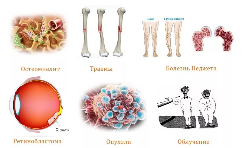 Деформирующий остоз (болезнь Педжета).. Костная болезнь Педжета. Болезнь Педжета бедренная кость. Синдром ли фраумени