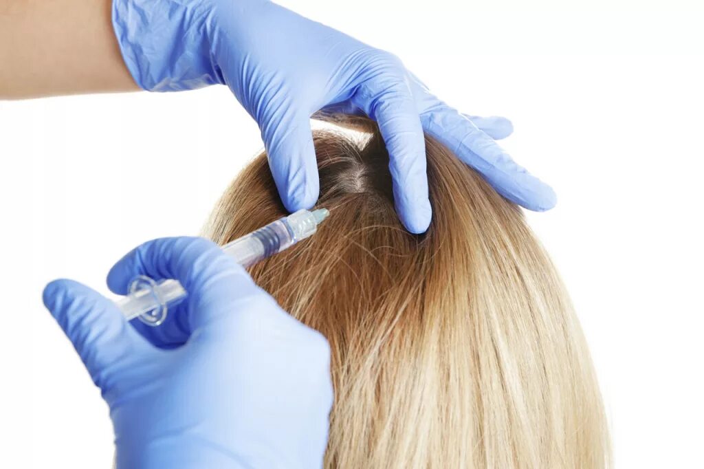Инъекции головы. Плазмотерапия волосистой части головы. PRP плазмотерапия для волос. Плазмолифтинг волосистой части головы. Мезотерапия для волос.