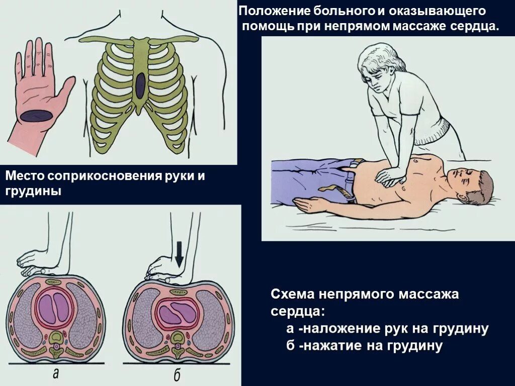 СЛР непрямой массаж сердца. Непрямой массаж сердца при СЛР. Наружный массаж сердца схема. Непрямой массаж сердца наложение рук. Компрессия грудной клетки при непрямом массаже сердца