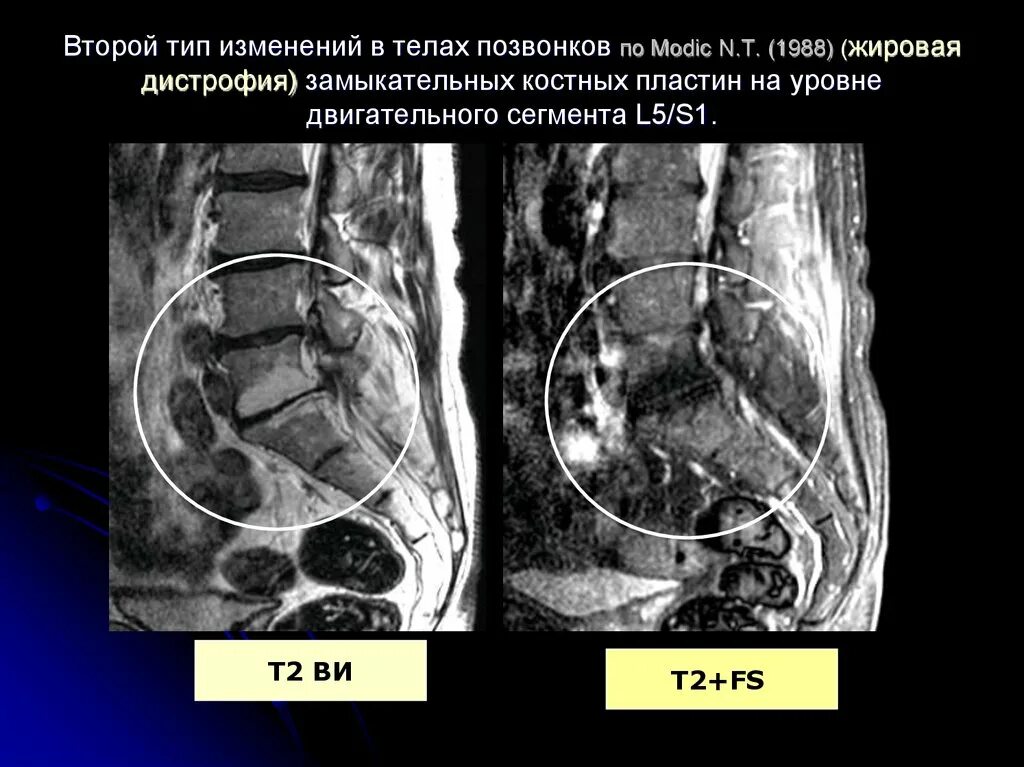 Очаги жировой дегенерации костного мозга Modic 2. Жировая дегенерация Modic тип2. Участок жировой дегенерации. Участки жировой дегенерации в телах позвонков.