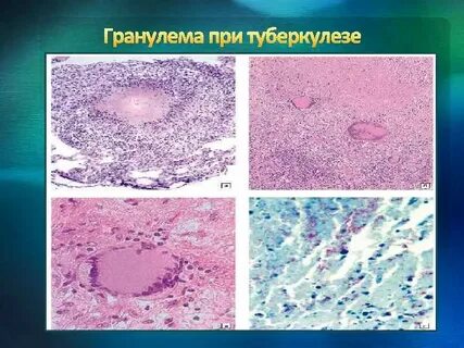 Гранулема туберкулеза