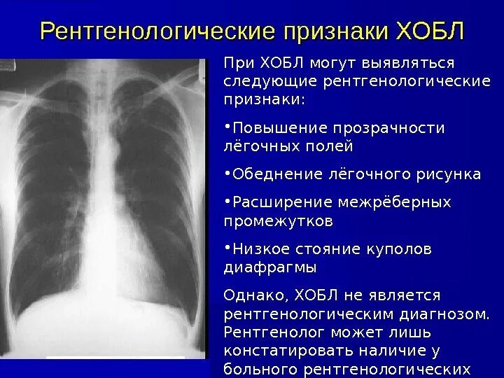 Без видимых патологий. Рентгенологические признаки эмфиземы легких. Заключение рентген при ХОБЛ эмфиземе. ХОБЛ рентгенологические признаки. ХОБЛ описание рентгенограммы.