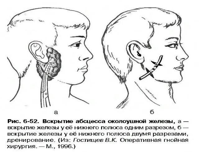 Операции на околоушной слюнной железы. Операции на околоушной слюнной железы. Пластика встречными треугольными лоскутами (метод а. Резекция околоушной слюнной железы. Операции на околоушной слюнной железе.