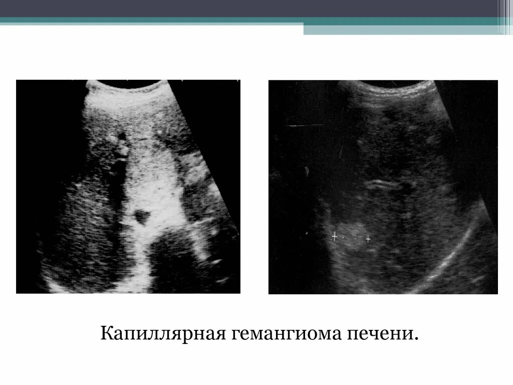 Очаговые гемангиомы печени. Кавернозная гемангиома печени на УЗИ. Дольчатая капиллярная гемангиома. Капиллярная гемангиома печени. Гемангиома левой доли печени.