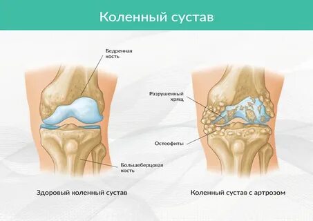 Коленные остеофиты лечение