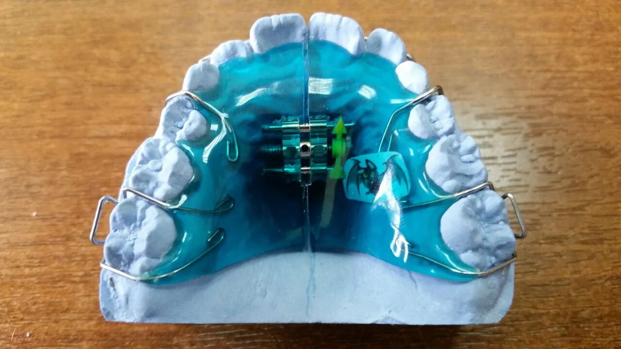 Аппарат Андрезена-Гойпля. Аппарат Андрезена Гойпля ортодонтия. Активатор Андрезена-Хойпля. Аппарат Андреаса Гойпля. Активатор андрезена