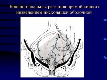После операции прямой кишки