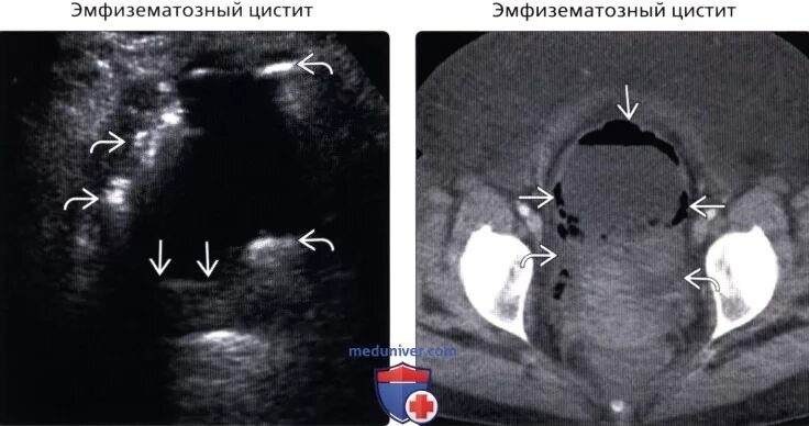 Диффузное утолщение стенок. Трабекулярность стенки мочевого пузыря. стенки мочевого пузыря на узи. стенки мочевого пузыря на кт. псевдодивертикулез стенок мочевого пузыря.