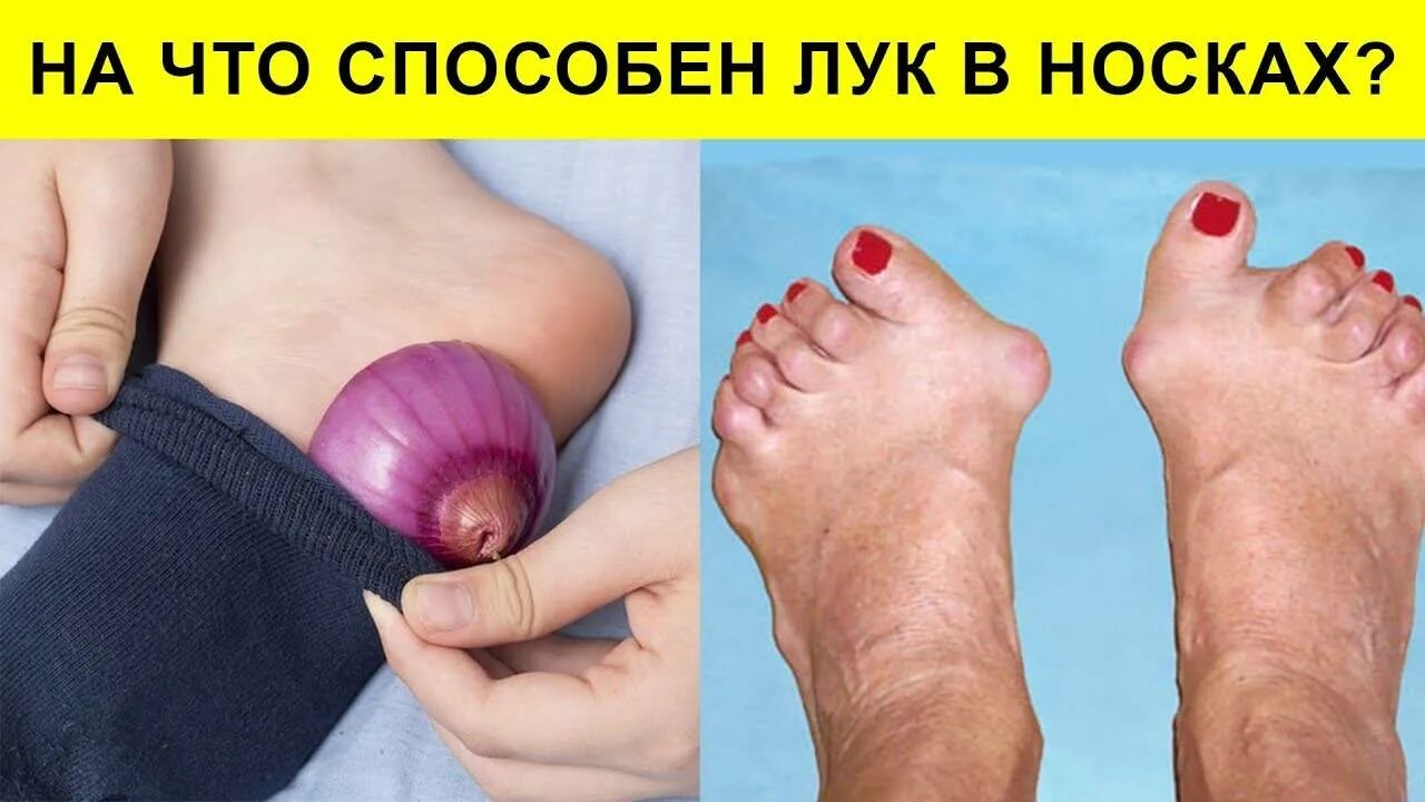 Лук положить в носок. Репчатый лук в носки на ночь. луковица в носки на ночь. ложим лук в носки на ночь. луковые компрессы на стопы.