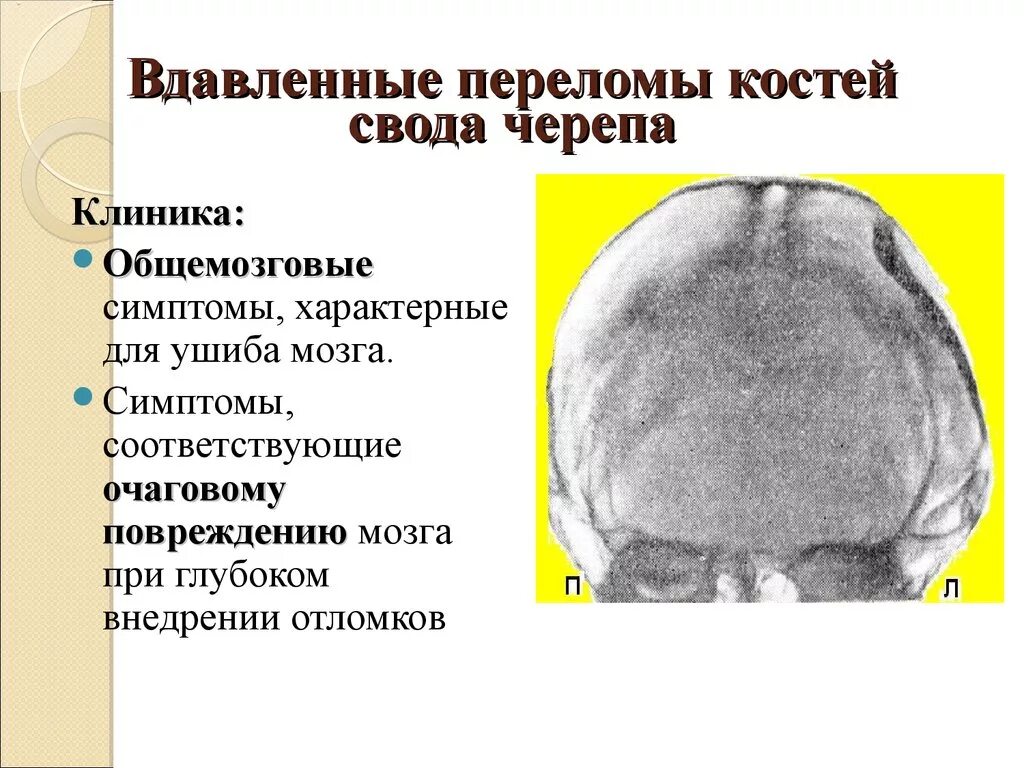 Перелом кости свода черепа. Клинические проявления перелома свода черепа. Клиника при переломах свода черепа. Клиника переломов костей черепп. Для перелома основания черепа характерен симптом:.