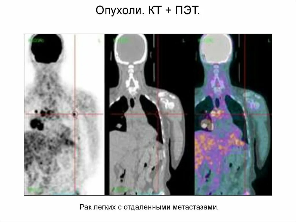 Отдаленные метастазы при раке. ПЭТ кт метастазы в легких.