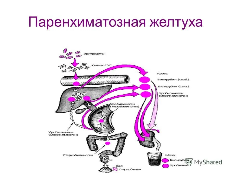 патогенез паренхиматозной желтухи схема. печеночная паренхиматозная желтуха. механизм развития печеночной желтухи. стадии паринхимаьогной дельухи. паренхиматозная желтуха патогенез.