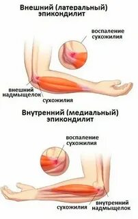 Болезнь теннисиста