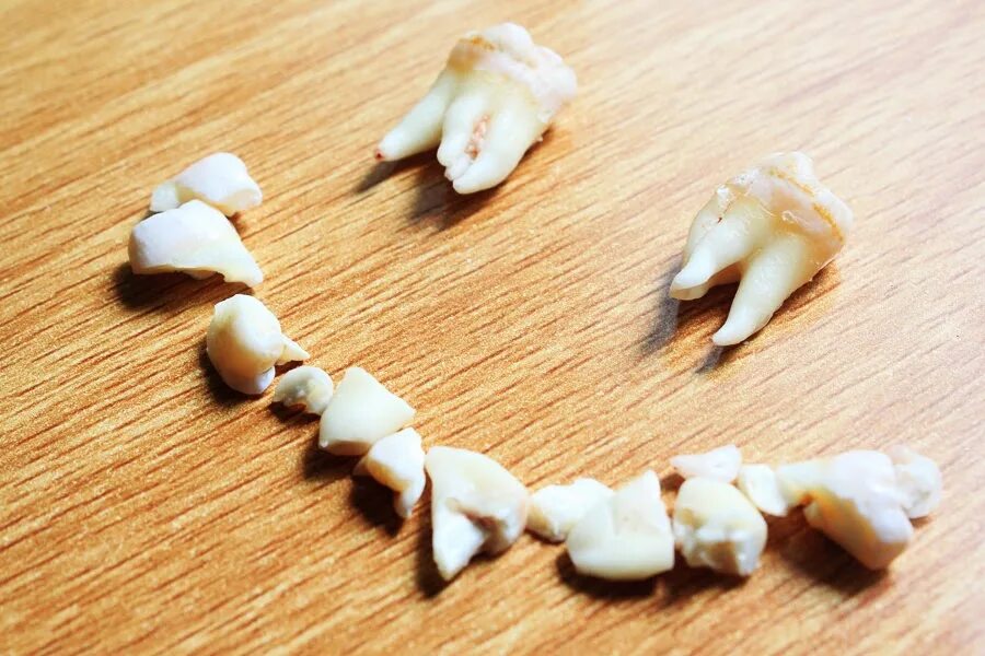 Сонник выпадение зубов без