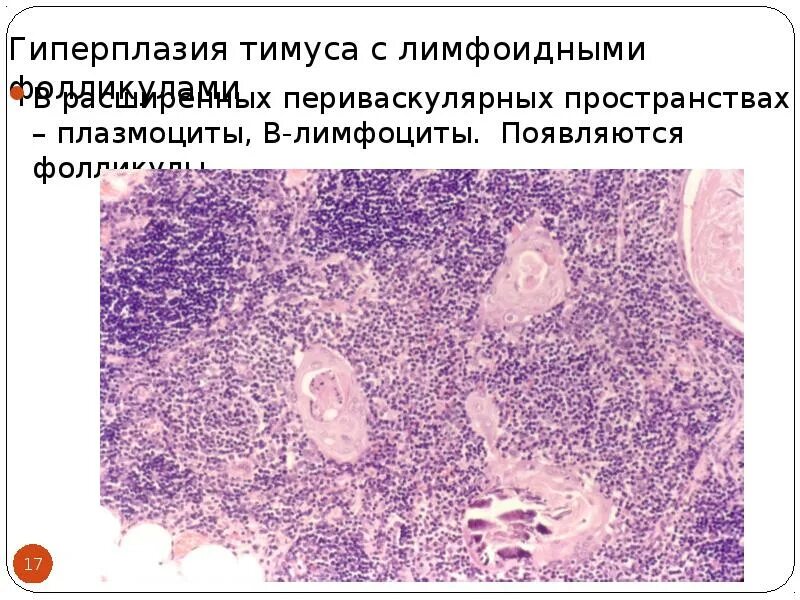 Гиперплазия резервных клеток. Фолликулярная гиперплазия лимфатического узла гистология. Гиперплазия лимфатического узла гистология. Фолликулярная гиперплазия лимфатического узла. Акцидентальная инволюция тимуса микропрепарат.
