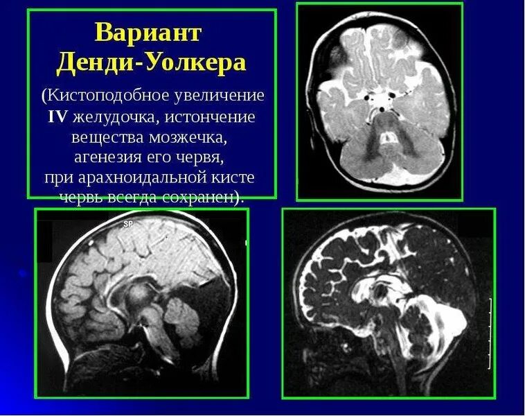 Денди уокера мрт. Гипоплазия мозжечка, аномалия денди-уокера. арахноидальная киста 4 желудочка. вариант денди уокера кт мрт. киста кармана блейка на кт.