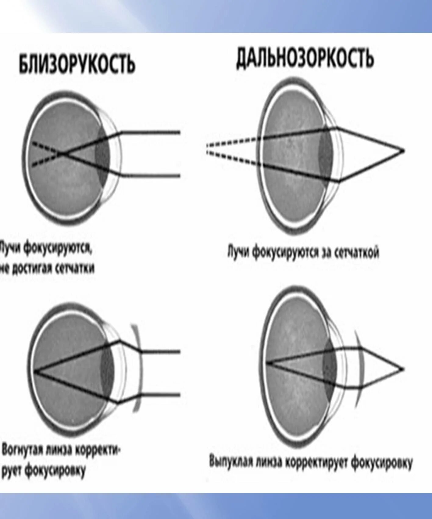 Дальнозоркость это когда. Дальнозоркость и близорукость плюс и минус. Зрение близорукость и дальнозоркость плюс и минус. Лучи фокусируются близорукость и дальнозоркость. Близорукость это плюс или минус.