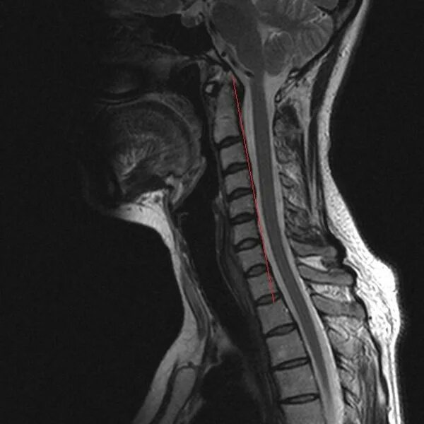 Мрт шейного отдела позвоночника. Мрт миелография спинного мозга. Мрт шейного отдела позвоночника норма. Мрт шейного отдела позвоночника и спинного мозга.