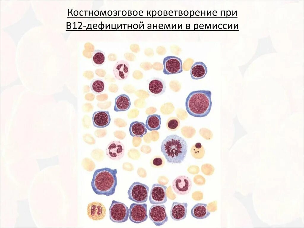 В12 при железодефицитной анемии. В12 фолиеводефицитная анемия картина крови. Б12 дефицитная анемия кровь. Картина крови при в12 дефицитной анемии. B12 дефицитная анемия ОАК.