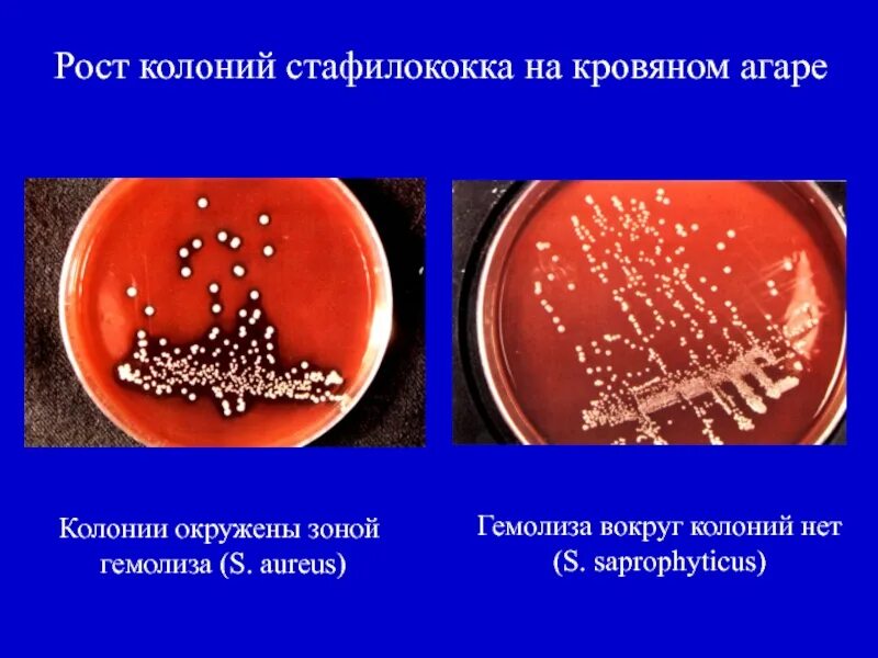 Колонии стафилококка на кровяном агаре. Колонии стафилококков на кровяном агаре и ЖСА. Стафилококк ауреус гемолиз на кровяном агаре. Золотистый стафилококк гемолизин бета гемолиз на кровяном агаре. Staphylococcus aureus среда