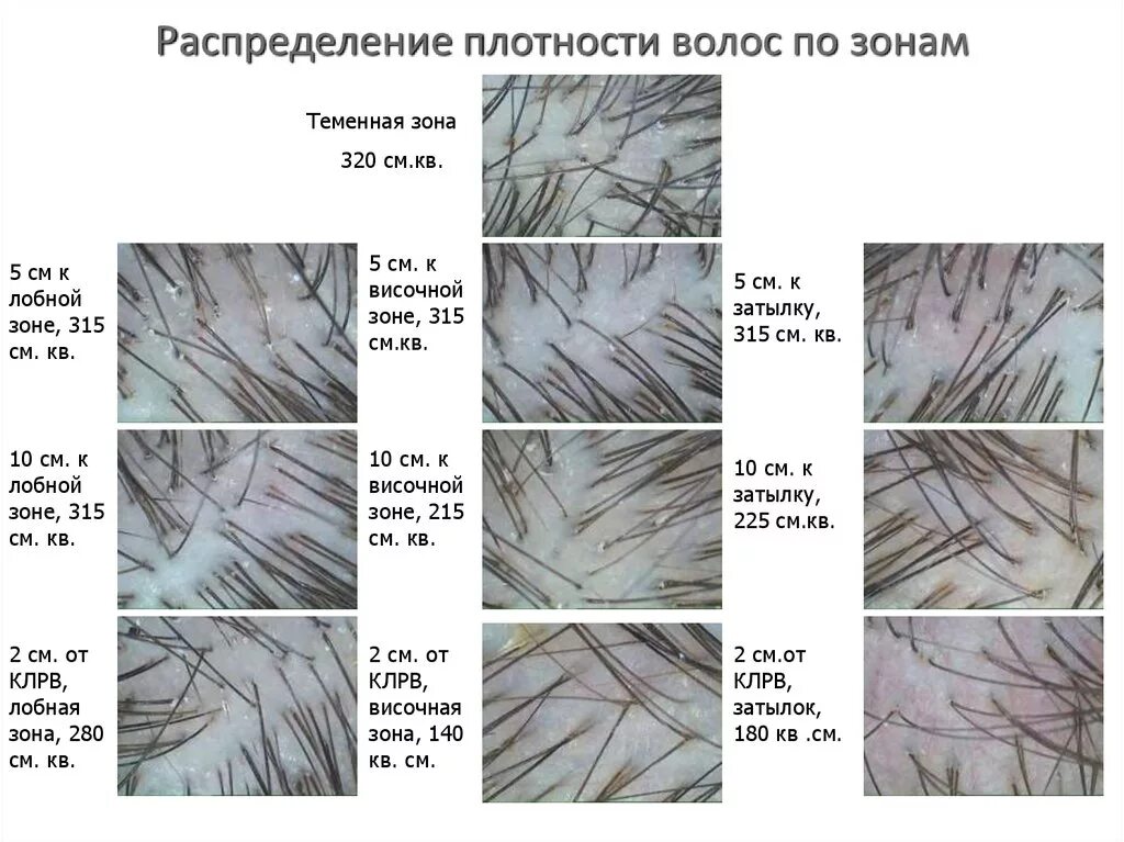 Распределение волос. Норма Кол-ва волос на кв сантиметр. Плотность роста волос. Зоны роста волос.