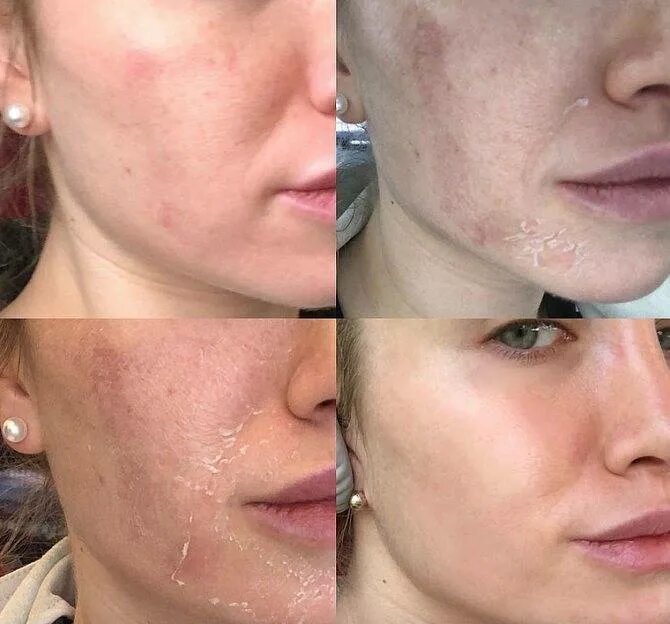 Пилинг в какое время делать. Пилинг в какое время делать. Пилинг в какое время делать. Лазерный пилинг фраксель. Пилинг в какое время делать.