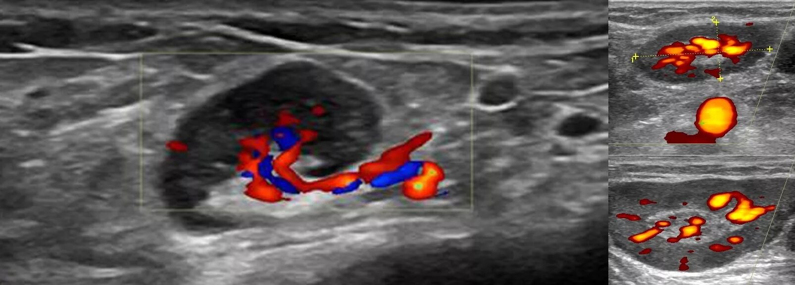 Как выглядит лимфоузел на узи. Воспаление лимфатические узлы узи. Лимфаденит узи лимфоузлов. Аксиллярные лимфоузлы узи. Метастазы лимфоузлов на узи.