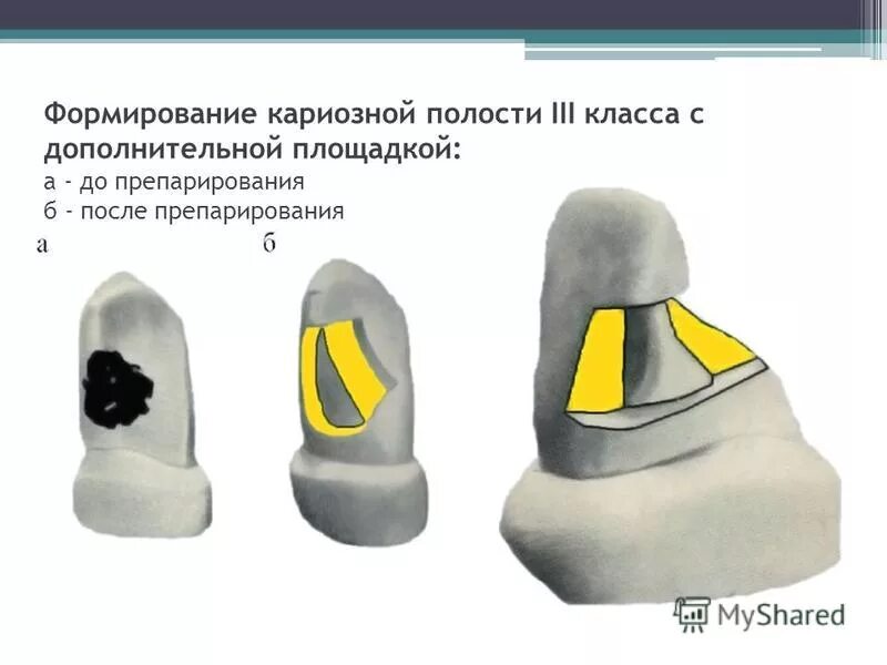 Полость 1 класса по блэку. Полость 1 класса по блэку