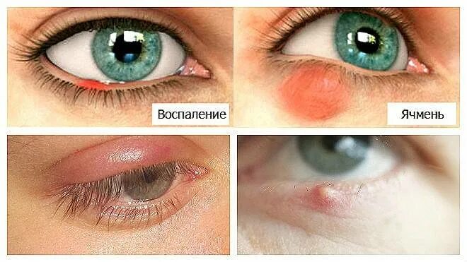 Можно с ячменем ходить в школу