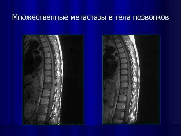 Метастазы по всему скелету. Метастазы в позвоночнике рентген. метастазы позвонков мрт.