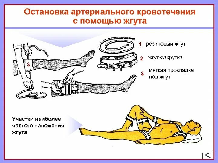 Жгут можно накладывать при кровотечении. Остановка артериального кровотечения наложение жгута. Остановка артериального кровотечения с помощью жгута. Методы остановки крови при артериальном кровотечении. Метод остановки кровотечения жгут.