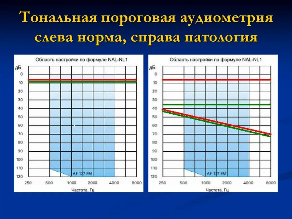 Тональная пороговая аудиограмма норма. Тональная пороговая аудиограмма норма и патология. Аудиограмма здорового человека норма. Тональная пороговая аудиометрия норма. Аудиограмма норма