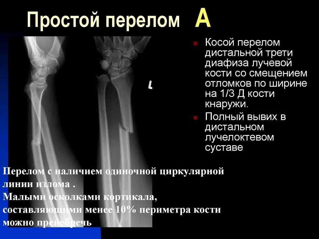 Диагноз перелома лучевой кости. Протокол рентген перелом локтевой кости. Перелом диафиза лучевой кости гипс. Локтевая кость перелом диафиза. Перелом диафиза локтевой кости рентген.