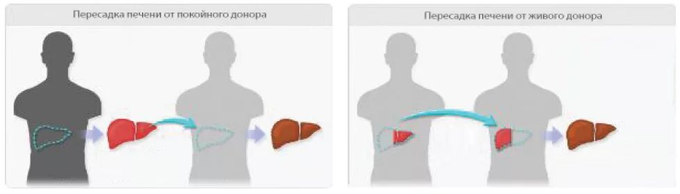 Пересадка печени стоимость